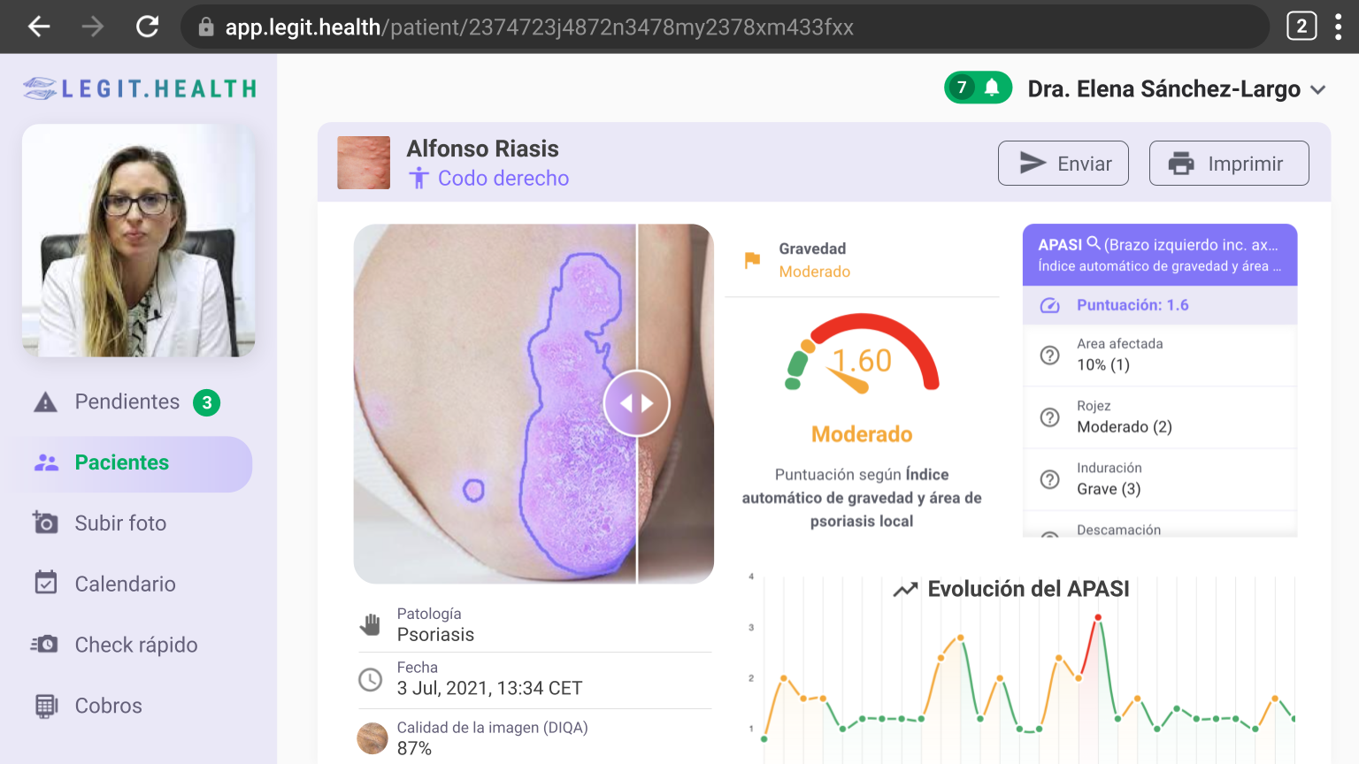 PASI Psoriasis